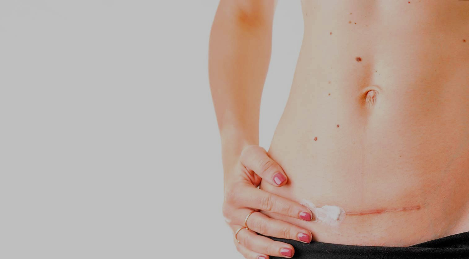 Are all scar creams the same?