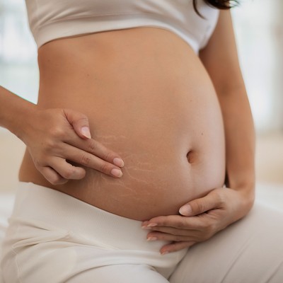 Trofolastín Anti-Estrías: Guía de uso para prevenir las estrías durante el embarazo 